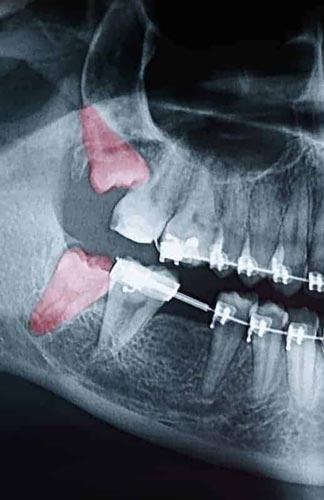MonitoringWisdomTeeth-tile