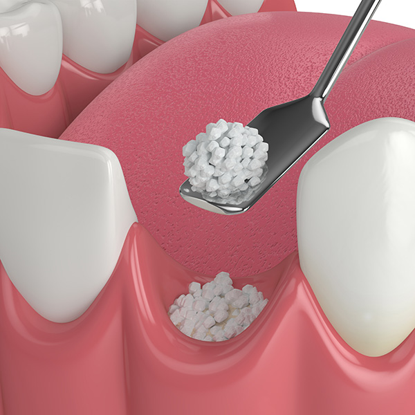 Learn about Bone Grafting