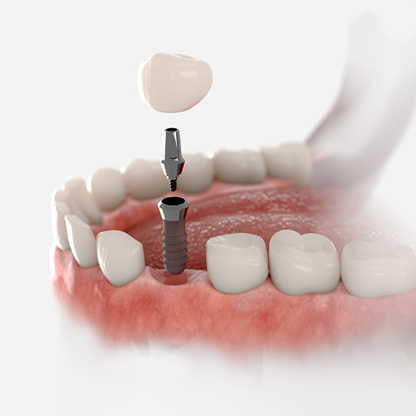Learn about Dental Implants