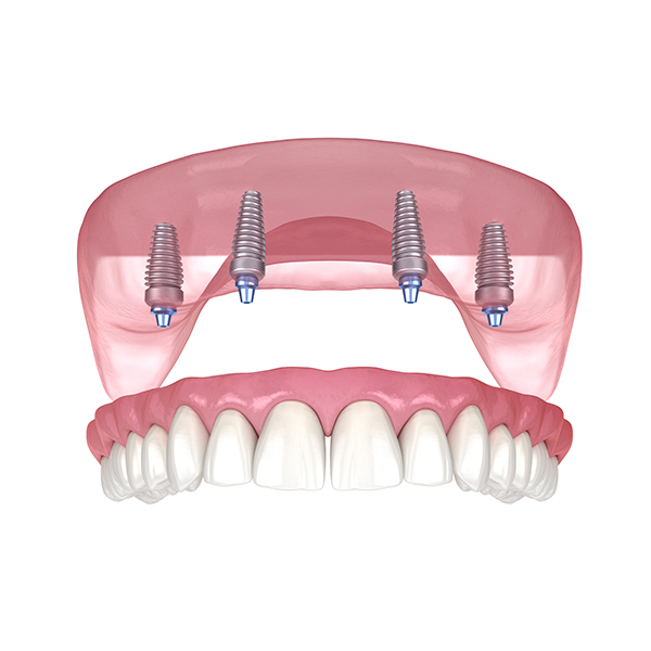 Learn about Pre-Prosthetic Surgery