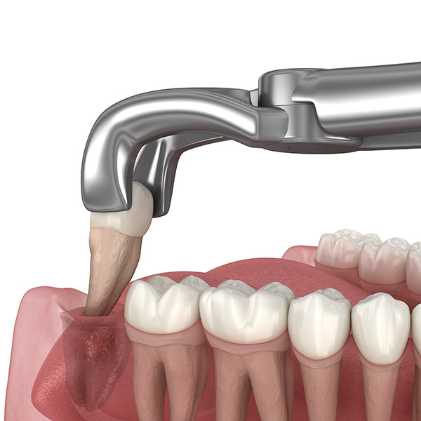 Learn about Tooth Extractions