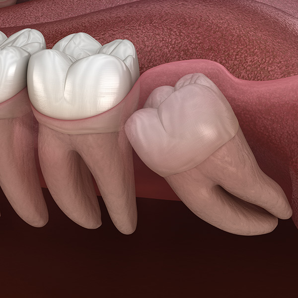 Learn about Wisdom Teeth Extractions