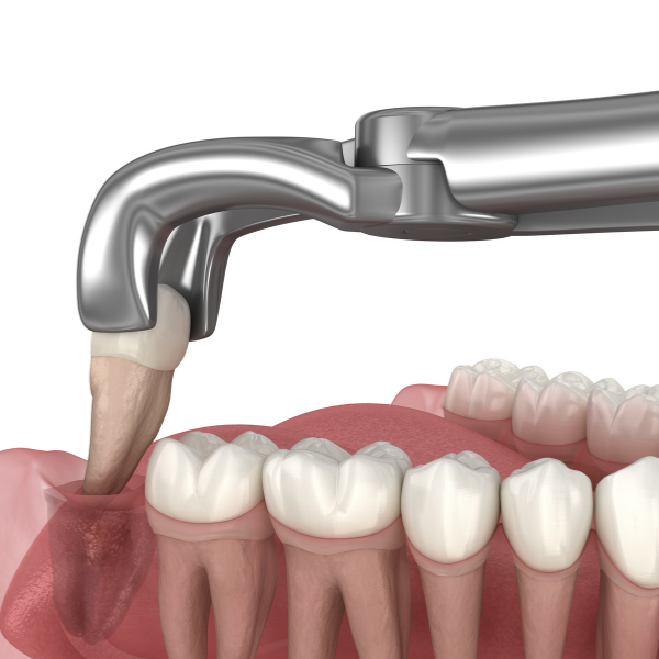 Wisdom tooth extraction