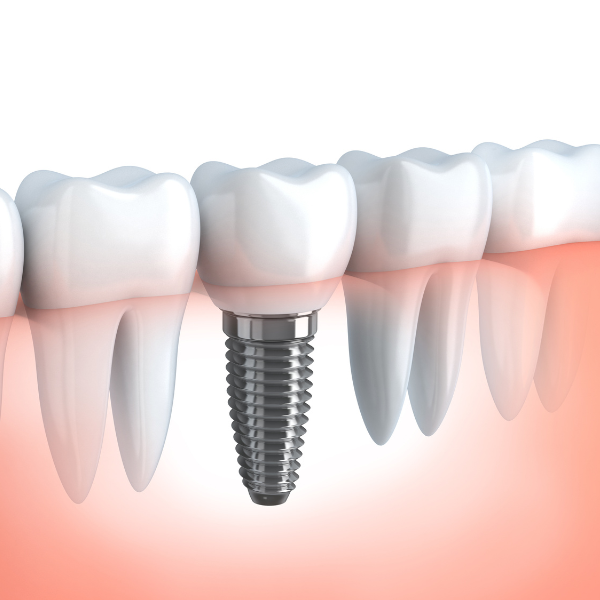 Dental implant
